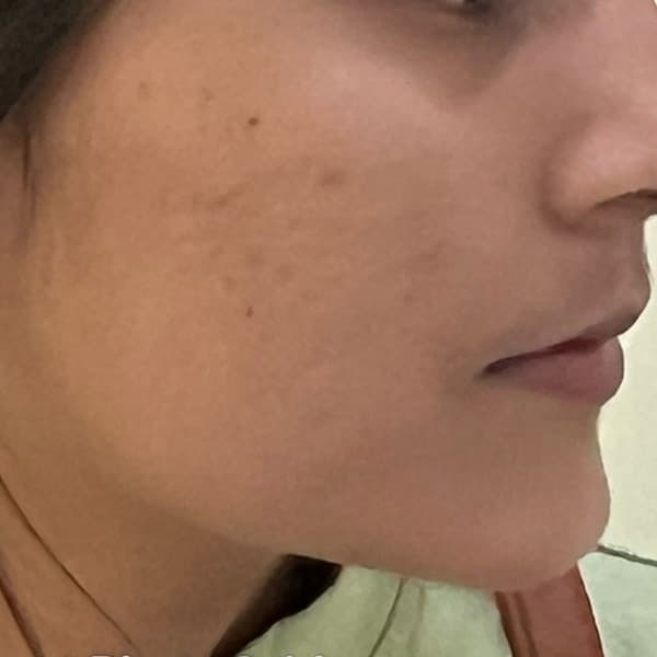 Acne — depois