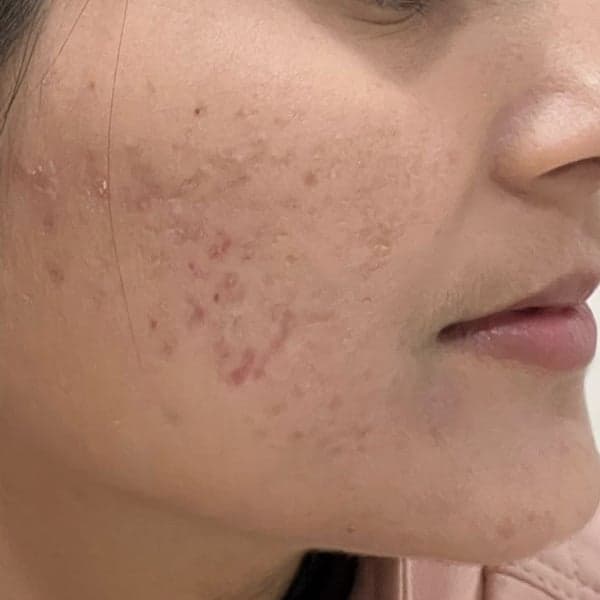 Acne — antes